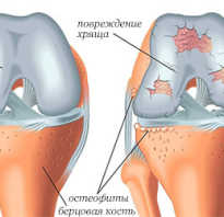 Полезные продукты при артрозе коленного сустава
