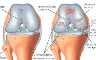 Полезные продукты при артрозе коленного сустава